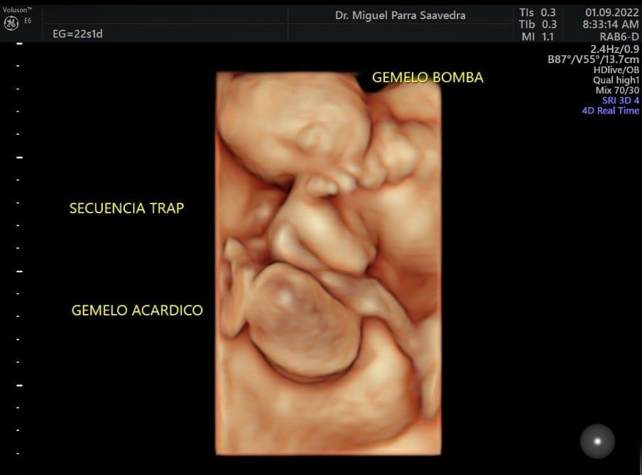 Ecografía a gemelos bomba y acárdic