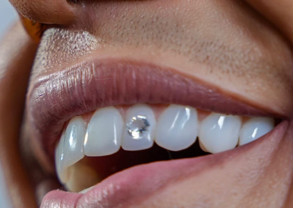 La dentadura es una prótesis dental en resina fotocurable, que incluye el diamante.