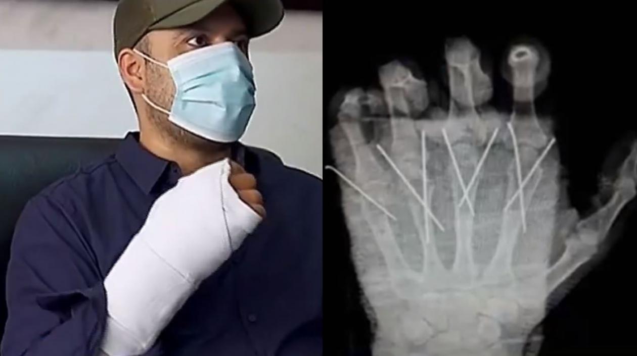 Al policía lograron reimplantarle la mano amputada. 