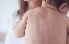 Los niños están más expuestos al contagio de la varicela.