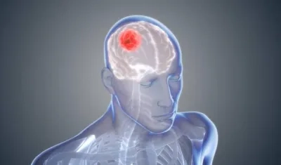 El glioblastoma es uno de los peores tumores cerebrales.