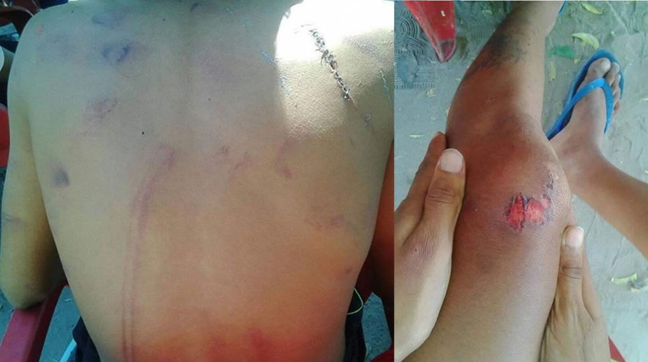 Así se ven la espalda y la rodilla del menor agredido por la Policía en Sabanagrande.