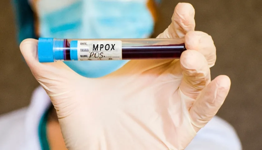 Prueba de sangre para detectar Mpox.