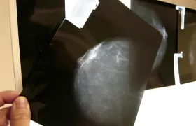 Fotografía de archivo de una prueba radiológica de mama.