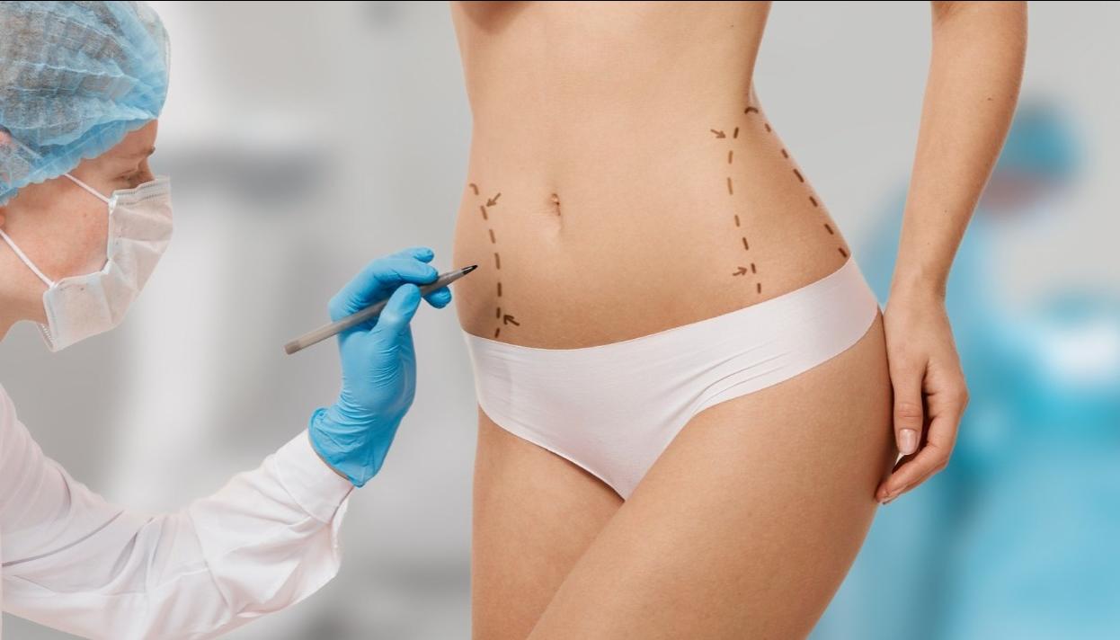 La liposucción fue el procedimiento quirúrgico más común en el mundo