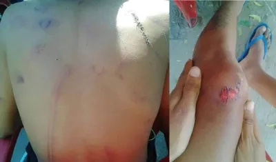  Así se ven la espalda y la rodilla del menor agredido por la Policía en Sabanagrande.